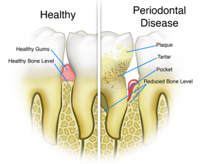 The Benefits of Periodontal Laser