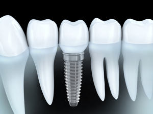 Dental-Implants-What-to-Expect