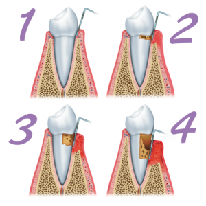 'preventing gum disease'