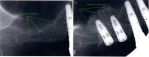 X-rays of a sinus lift