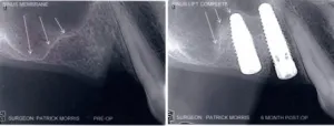 X-rays of a sinus lift