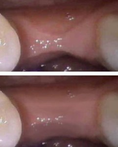 Ridge augmentation before and after photos