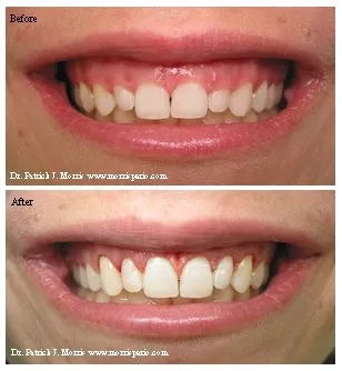 Periodontal plastic surgery before & after photos of person smiling