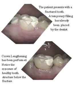 Crown lengthening before & after case study