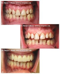 Crown lengthening before & after case study