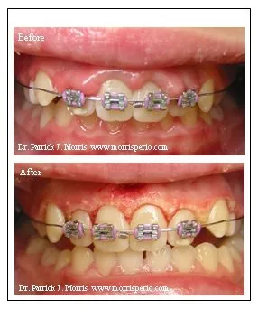 Cosmetic crown lengthening with orthodontics, before and after photos