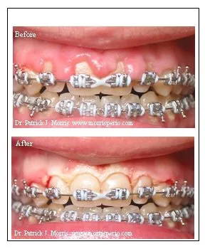 Gingivectomy before and after photos