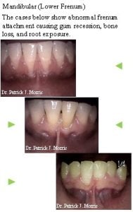 Frenectomy case study, before and after photos