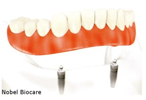 Illustration of dentures with two dental implants