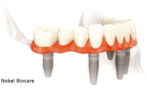 Illustration of dentures anchored by dental implants
