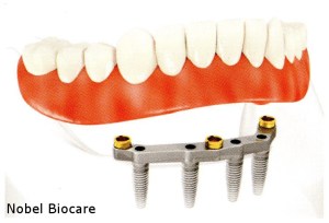 Illustration of dentures with multiple dental implants