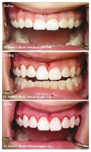 Before & after crown lengthening, case study photos