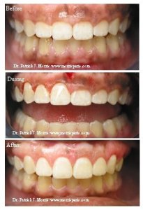 Before & after crown lengthening, case study photos
