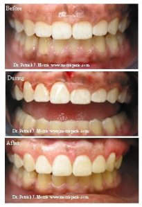 Before & after crown lengthening, case study photos