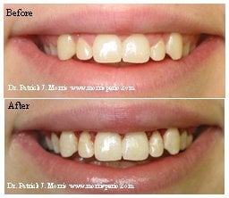 Before & after crown lengthening, case study photos
