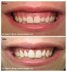 Before & after crown lengthening, case study photos