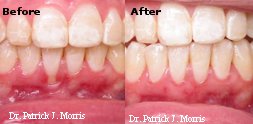 Mouth before & after gum grafting to treat gum recession