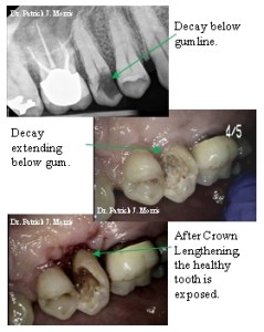 Crown lengthening process x-ray and photos