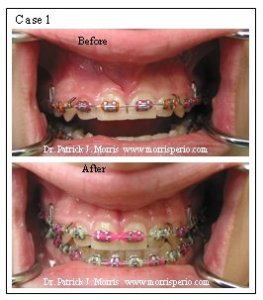 Frenectomy case study, before and after photos