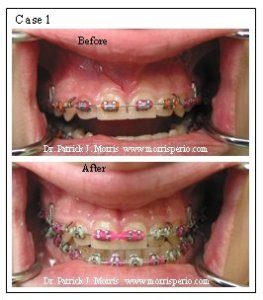 Frenectomy case study, before and after photos