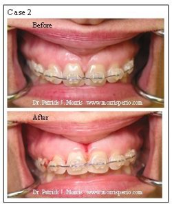 Frenectomy case study, before and after photos