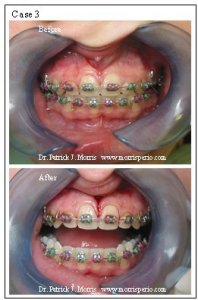 Frenectomy case study, before and after photos