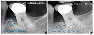 X-ray showing tissue engineering