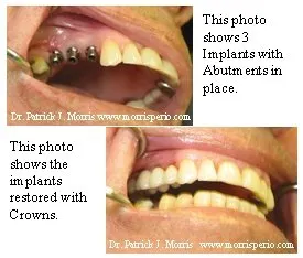 Dental implants case study photos