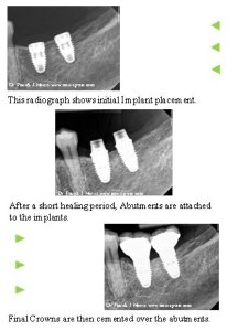 Patient case study with dental implant x-rays