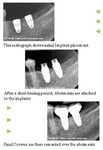 Patient case study with dental implant x-rays