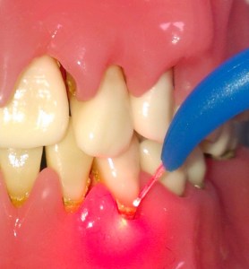 Laser gum therapy photo