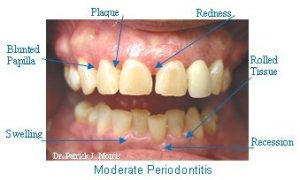 Image of moderate periodontitis
