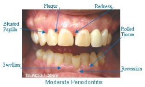 Image of moderate periodontitis